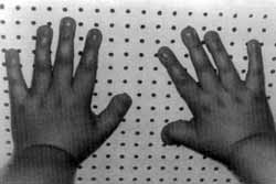 Rubinstein-Taybi syndrome (broad thumb-hallux syndrome)