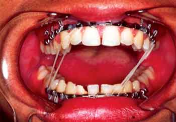 TRATAMENTO PARA Fratura Mandibular