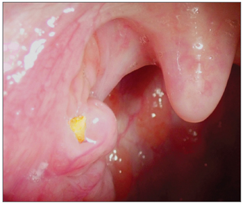 BJORL - Brazilian Journal of Otorhinolaryngology