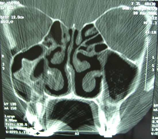 Osteoma de mandíbula: relato de caso